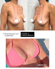 Mastopexia - Clínica Copacabana