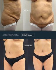 Abdominoplastia - Clínica Copacabana