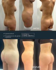 Aumento glúteos - Clínica Copacabana