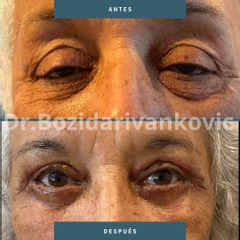 Blefaroplastia - Dr. Bozidar Ivankovic