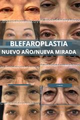 Blefaroplastia - Dr. Bozidar Ivankovic