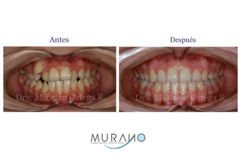 Ortodoncia antes y después - 626724