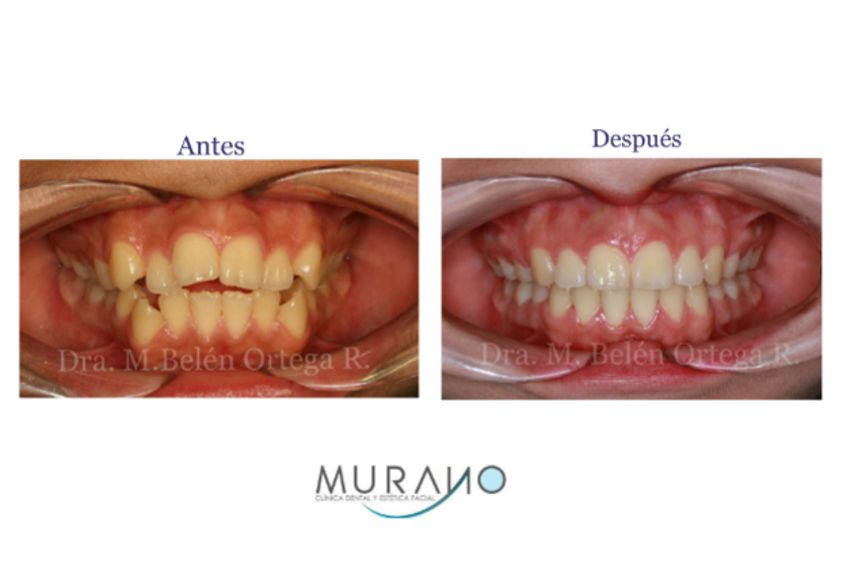 Ortodoncia antes y después - 626725