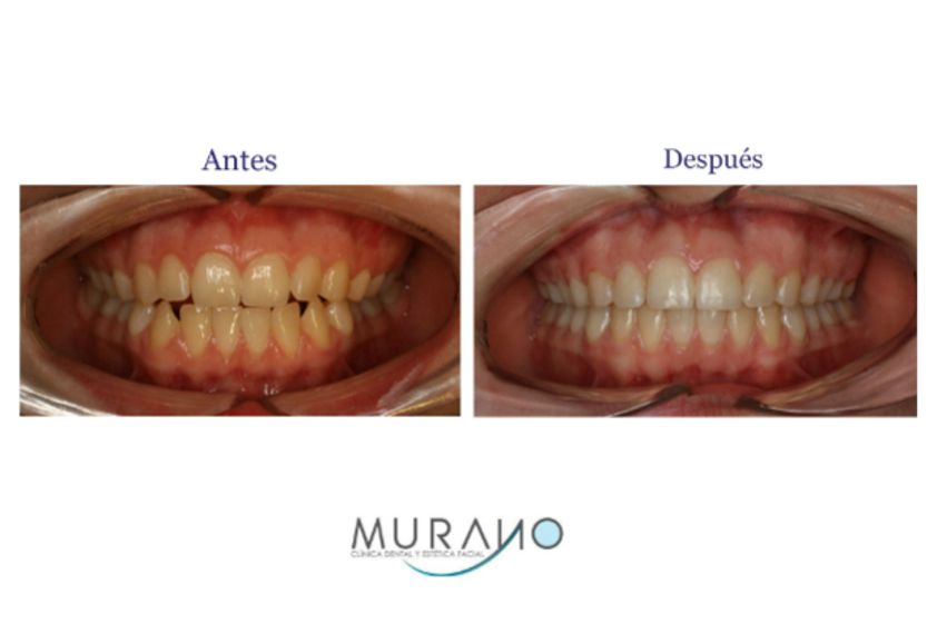 Blanquear dientes antes y después - 626859