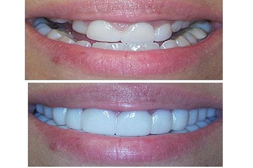 Brackets antes y después - 487061