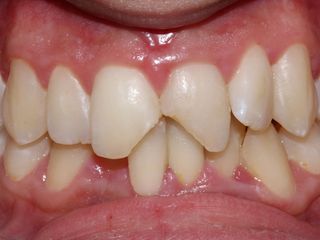 Restautaciones dentales