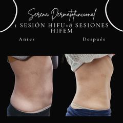 HIFU - Serena Dermatofuncional