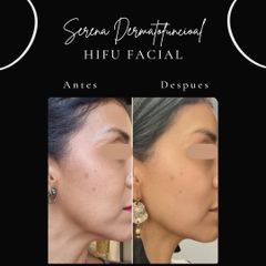 HIFU - Serena Dermatofuncional