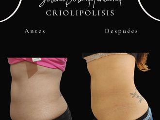 Criolipólisis antes y después - 866295