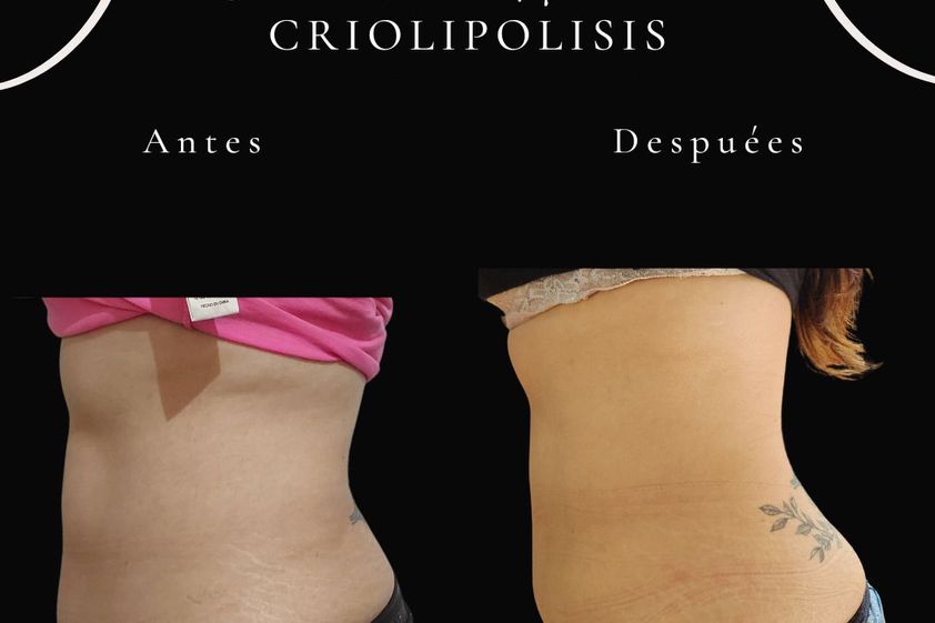 Criolipólisis antes y después - 866295