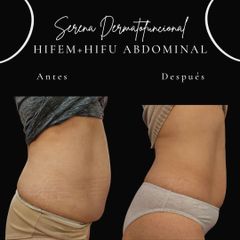 HIFU - Serena Dermatofuncional