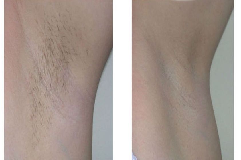 Depilación Láser antes y después - 487069