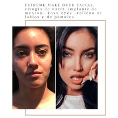 Extreme make over facial - Dr. Sebástian Cosentino
