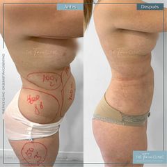 Liposucción - Dr. Sebástian Cosentino