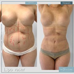 Liposucción - Dr. Sebástian Cosentino