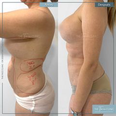 Liposucción - Dr. Sebástian Cosentino