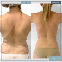 Liposucción - Dr. Sebástian Cosentino