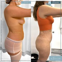 Liposucción - Dr. Sebástian Cosentino