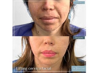 Lifting Cervico Facial