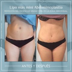Lipoabdomindoplastia - Dr. Sebástian Cosentino