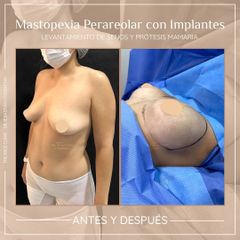 Mastopexia - Dr. Sebástian Cosentino