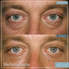 Blefaroplastia - Dr. Sebástian Cosentino