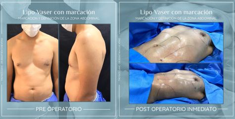 Liposucción - Dr. Sebástian Cosentino