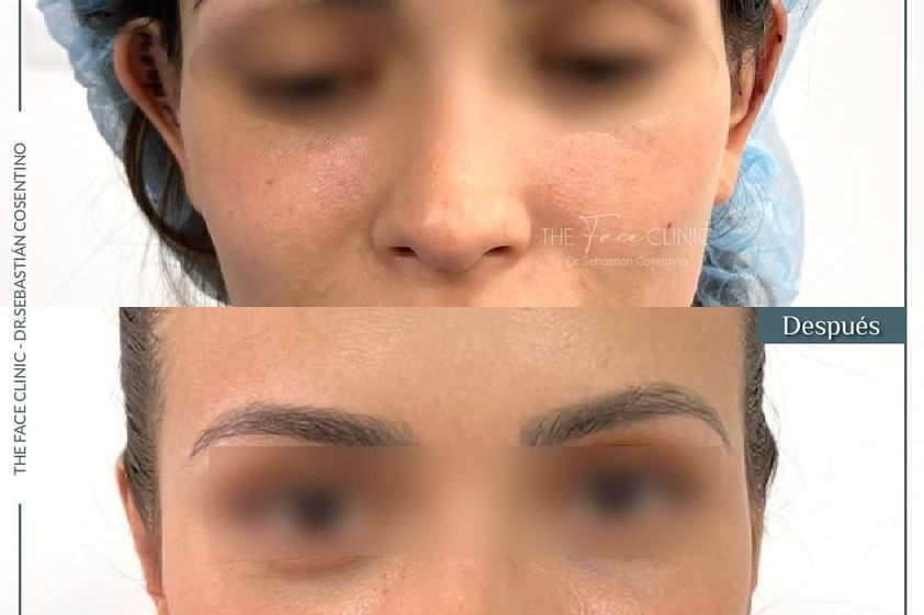 Otoplastia antes y después - 865361