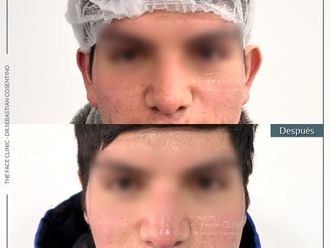 Otoplastia antes y después - 865362