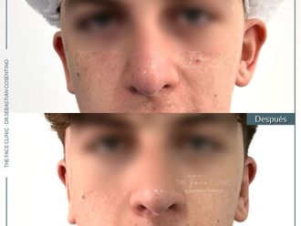 Otoplastia antes y después - 865364