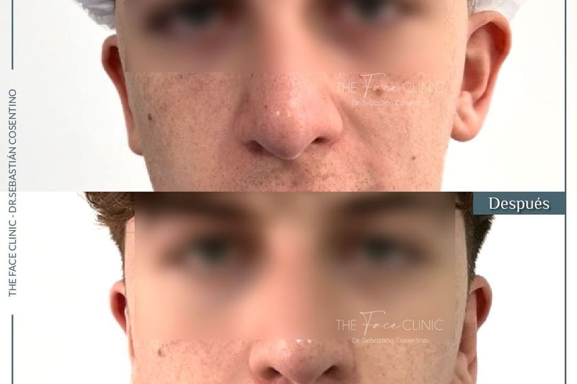 Otoplastia antes y después - 865364