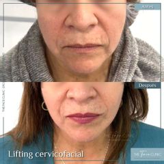 Lifting cervical - Dr. Sebástian Cosentino