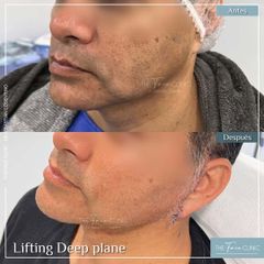 Lifting Facial - Dr. Sebastian Cosentino