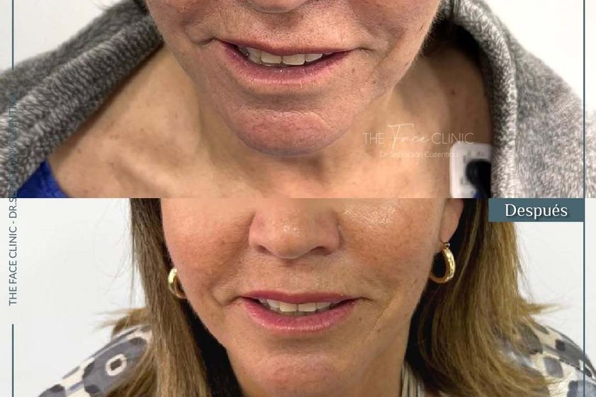 Lifting antes y después - 872230