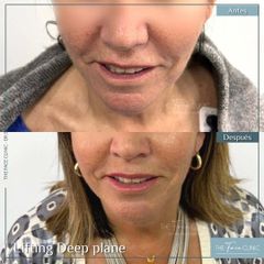 Lifting Facial - Dr. Sebastian Cosentino