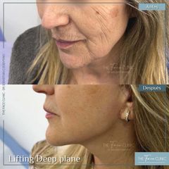 Lifting Facial - Dr. Sebastian Cosentino