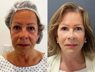 Lifting antes y después - 878227