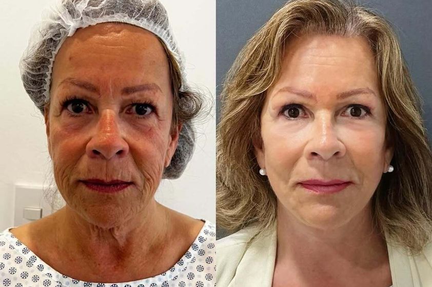 Lifting antes y después - 878227