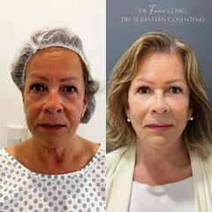 Lifting Cérvico - Dr. Sebástian Cosentino