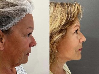 Lifting antes y después - 878228