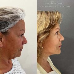 Lifting Cérvico Dr. Sebástian Cosentino