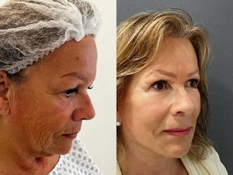 Lifting antes y después - 878229