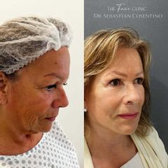 Lifting Cérvico Facial Deep + Blefaroplastia - Dr. Sebástian Cosentino