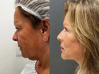 Lifting antes y después - 878230