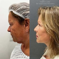 Lifting Cérvico Facial - Dr. Sebástian Cosentino