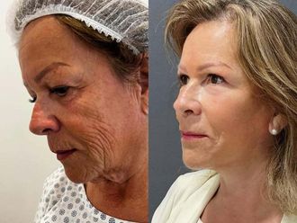 Lifting antes y después - 878231