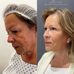Lifting Cérvico Facial - Dr. Sebastián Cosentino