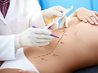 Abdominoplastía 