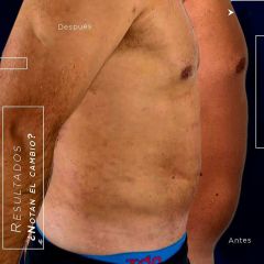 Liposucción - Dr. Antonio Previtera