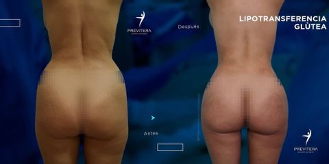 Liposucción - Dr. Antonio Previtera